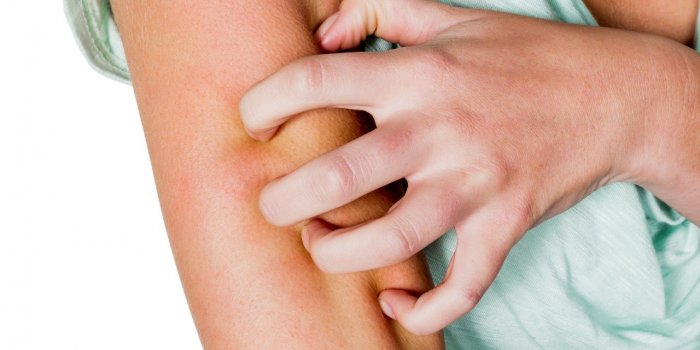 Urticaire : 7 remedes naturels pour soulager la crise