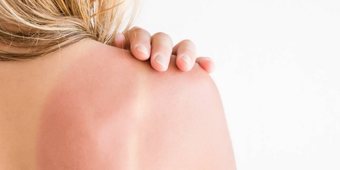 7 plantes qui soulagent les coups de soleil