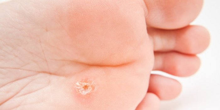 Verrue plantaire : comment les enlever naturellement ?